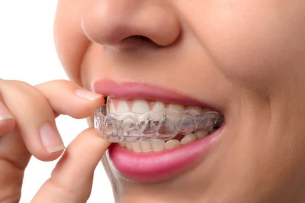 Inman aligners